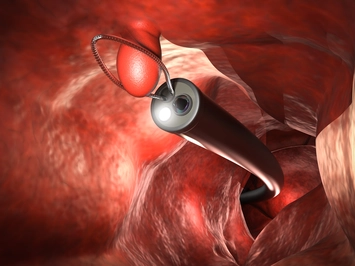Colon Polyp Sensor Removal with Cobodoc: 3D Rendering Endoscope Innovation