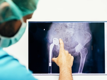 Doctor Examining X-ray Image of Hip Prosthesis